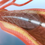 angioplasty