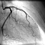 coronary angiography